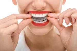 Clear Braces: Everything You Wanted to Know About Them