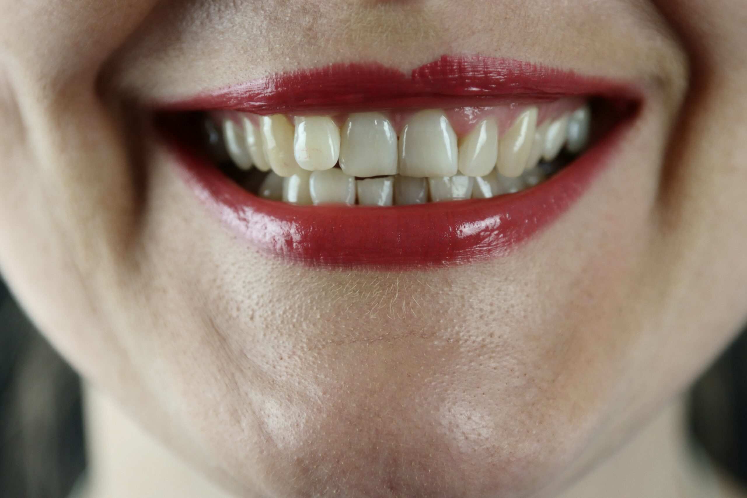 crooked teeth