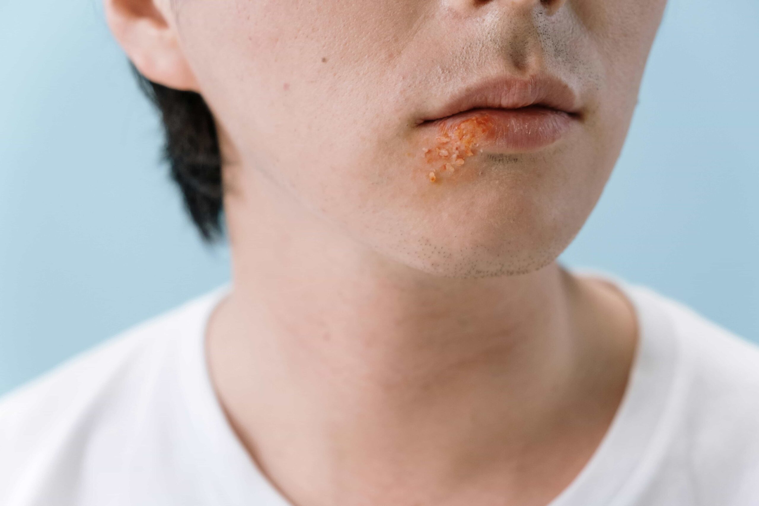 canker sores