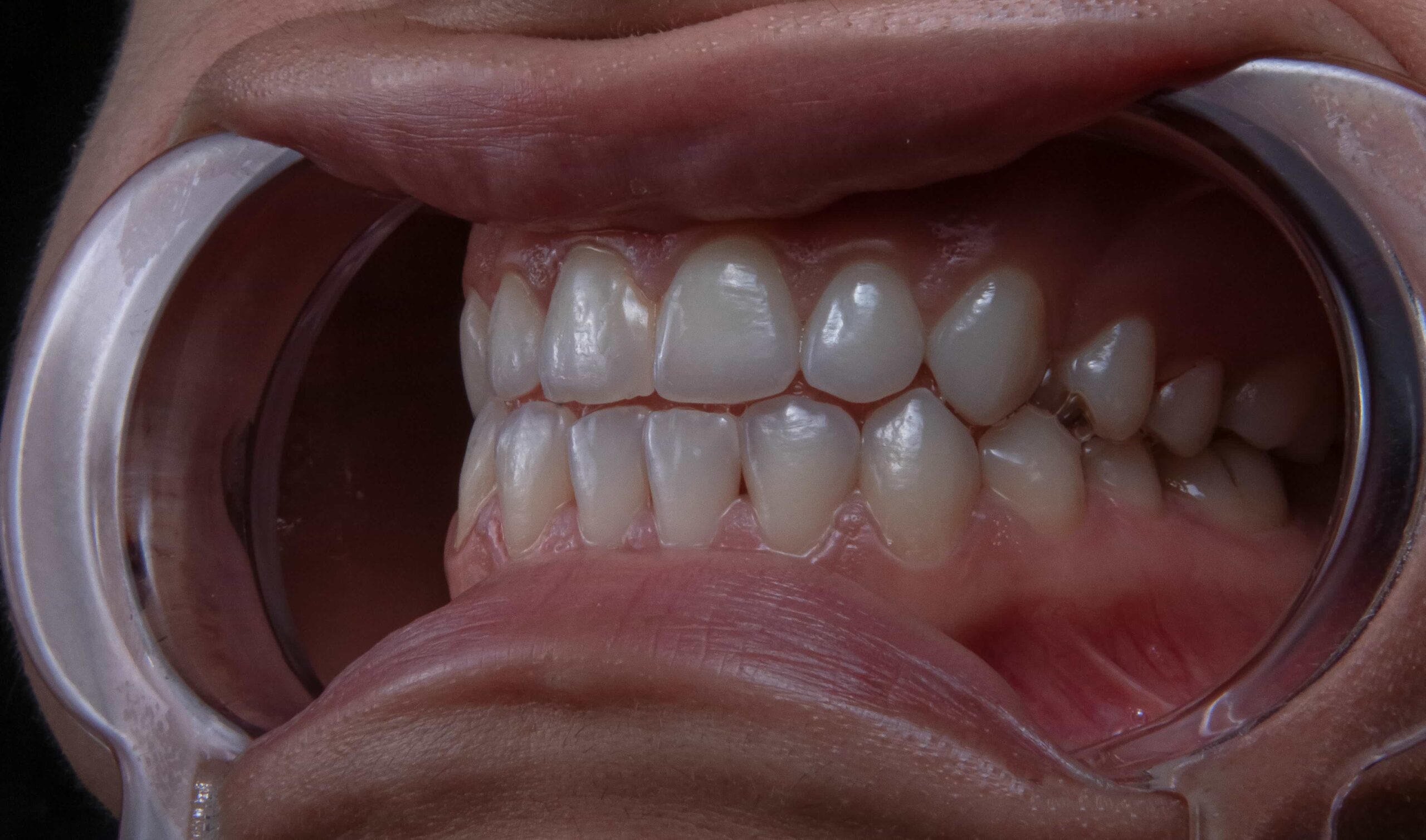 teeth in orthodontic brace
